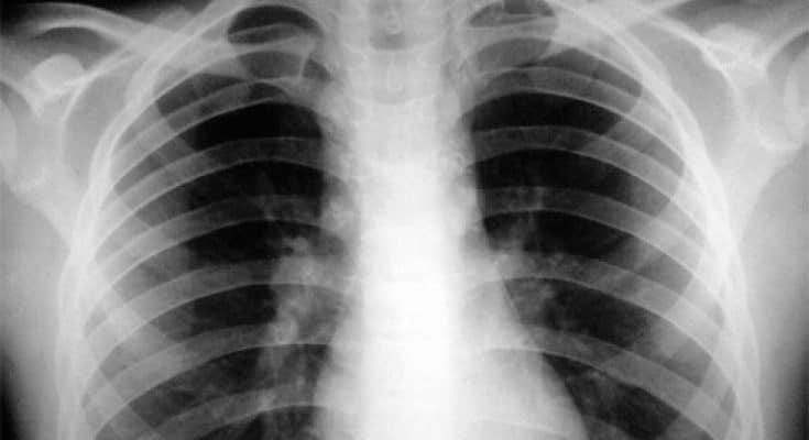 запорожье туберкулез